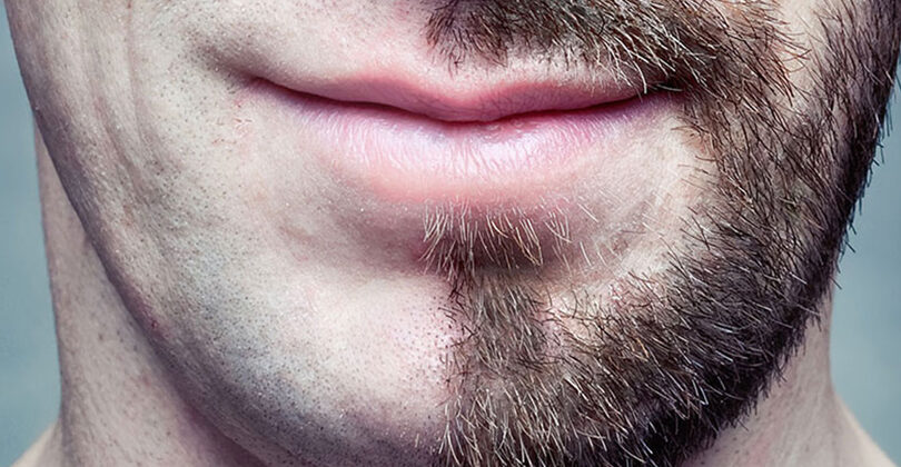 La greffe de barbe : une barbe pleine et dense