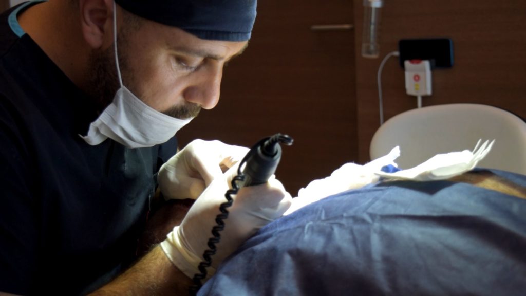 Intervention FUE en bloc